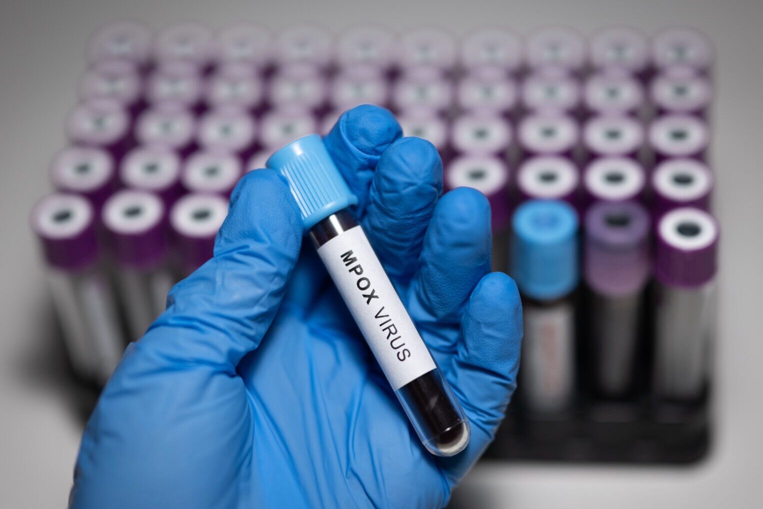 An mpox blood test tube is seen among other blood test tubes. Though the newest strain of the disease has not yet been detected in the United States, public health departments are preparing for the possibility. (Hakan Nural/Anadolu via Getty Images)